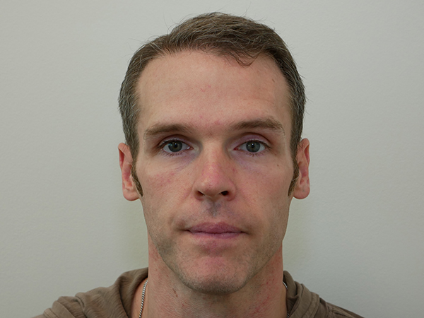 Hair Restoration