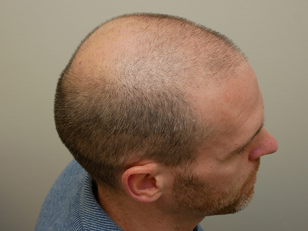Hair Restoration