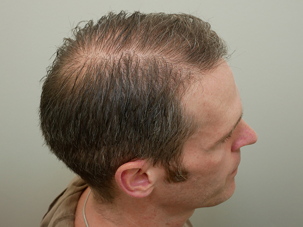 Hair Restoration