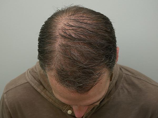 Hair Restoration