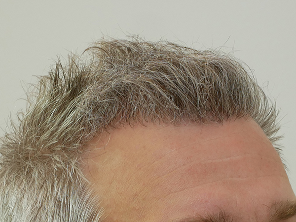 Hair Restoration