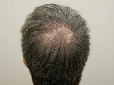 Hair Restoration