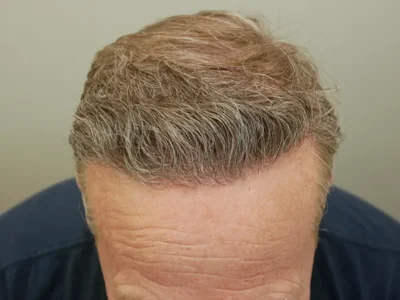 Hair Restoration