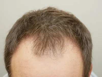Hair Restoration