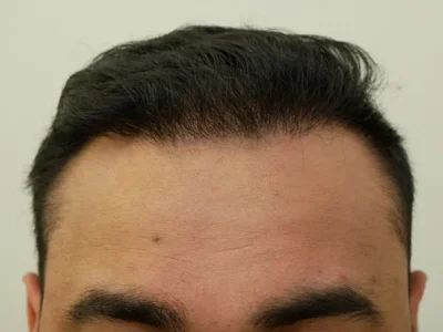 Hair Restoration