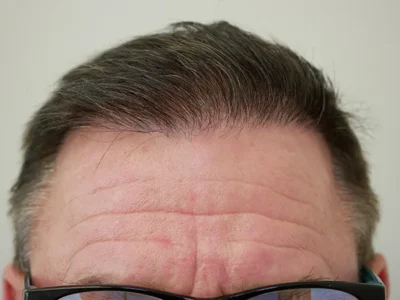 Hair Restoration