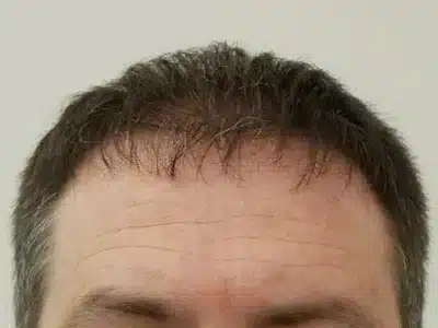 Hair Restoration