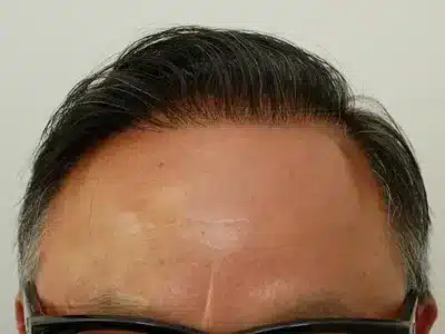 Hair Restoration