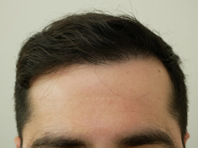 Hair Restoration