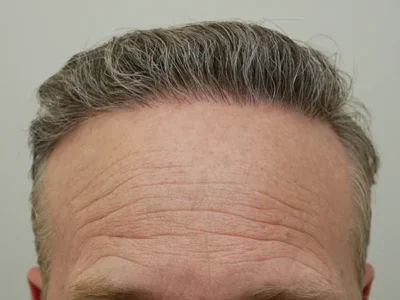 Hair Restoration