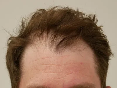Hair Restoration