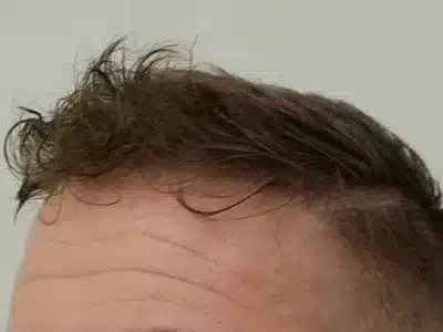 Hair Restoration