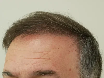 Hair Restoration