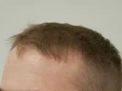 Hair Restoration
