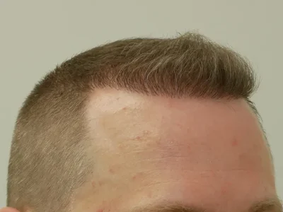 Hair Restoration
