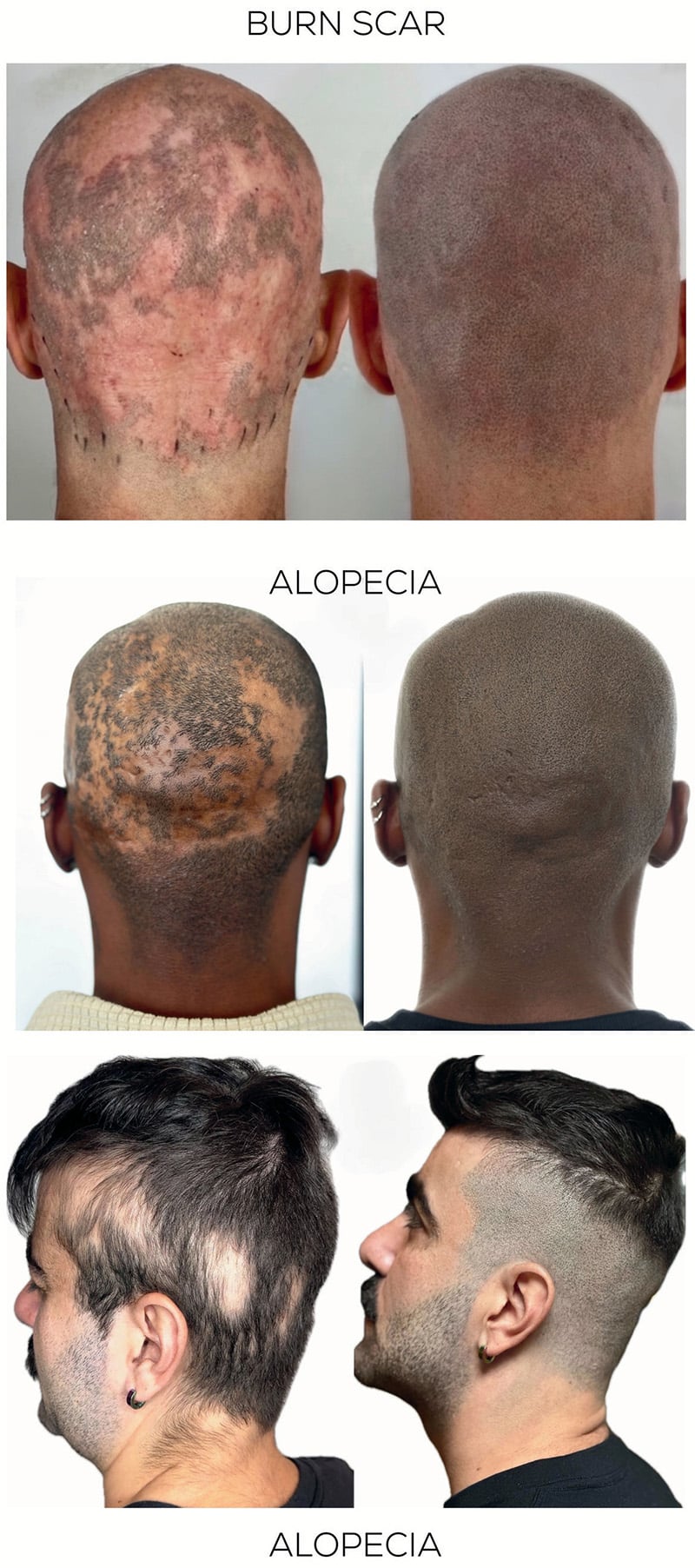 Scalp Micropigmentation before and after