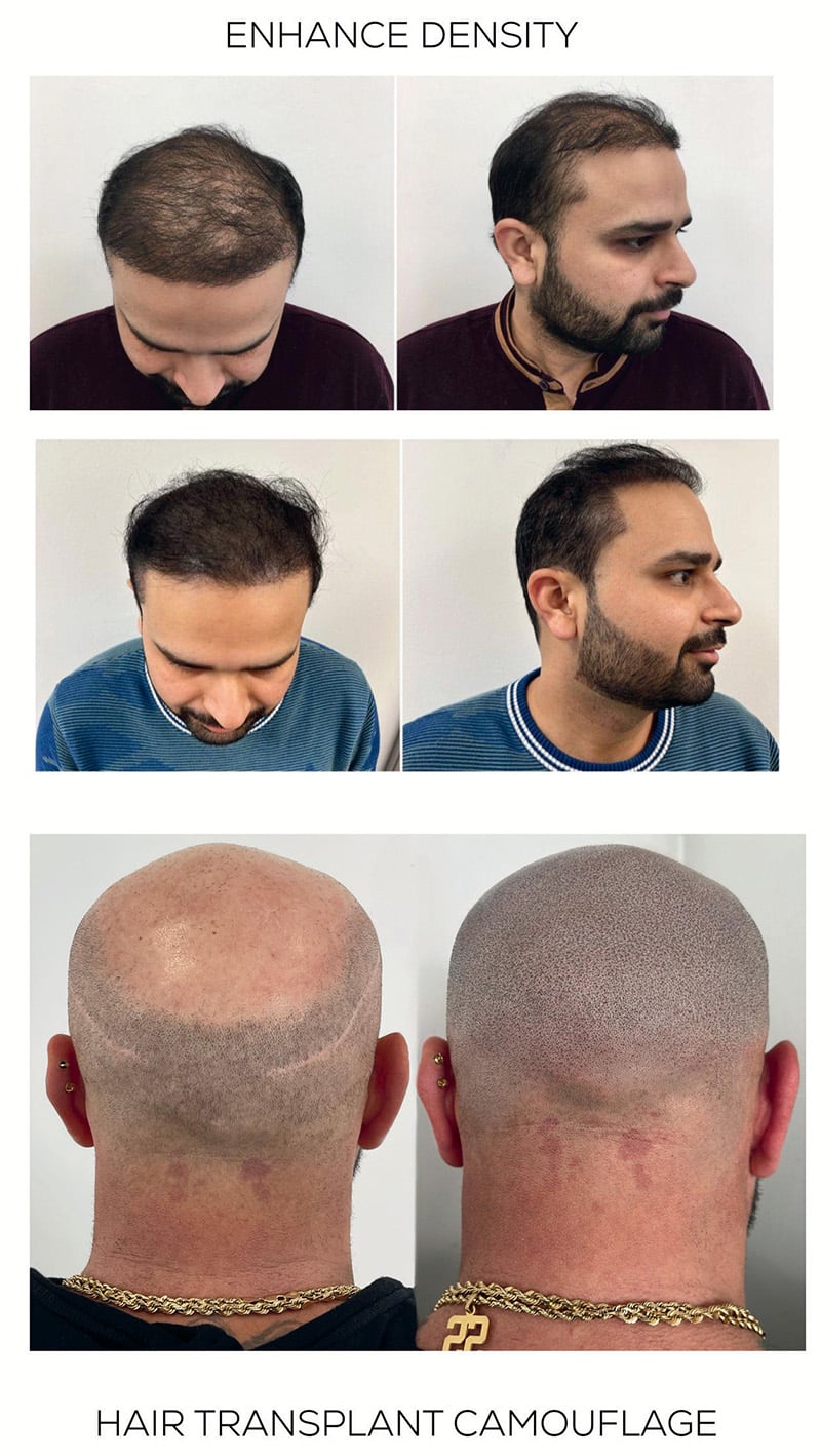 Scalp Micropigmentation before and after