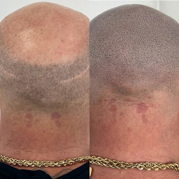 SCALP MICROPIGMENTATION (SMP) Before and After