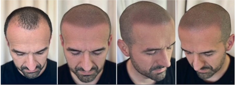 Scalp Micropigmentation before and after